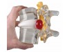 Herniated Disc Simulator