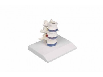 Lumbar Vertebrae With Prolapsed Inter Vertebral Discs With Stand