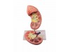 Kidney With Adrenal Gland 2-Times Enlarged 2-part