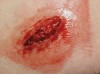 Ez Wounds Casualty Simulation Set Basic